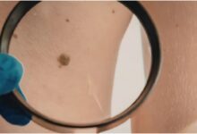 Skin Check Essentials in Melbourne: Ensuring Your Dermatological Well-being